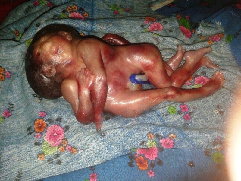 विचित्र रूप मे आपस मे जुडे  बच्चो ने लिया जन्म की तत्कालीन मृत्यु