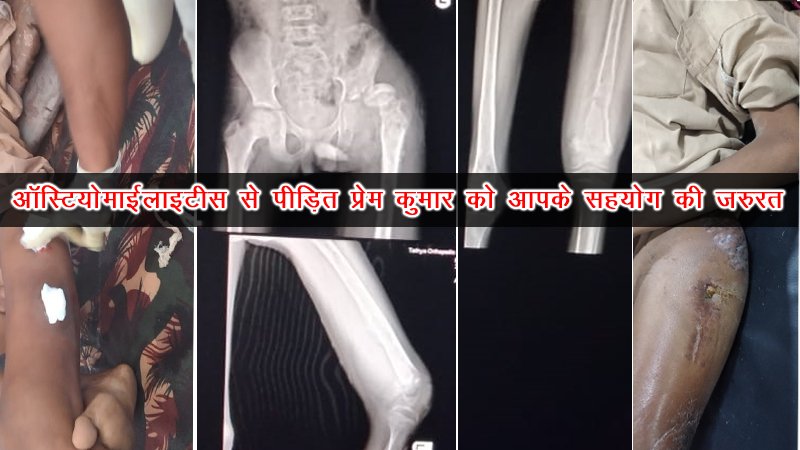 ऑस्टियोमाइलाइटिस से पीड़ित विध्यार्ती के लिये शिक्षक ने जुटा लिये 1.5 लाख रूपये