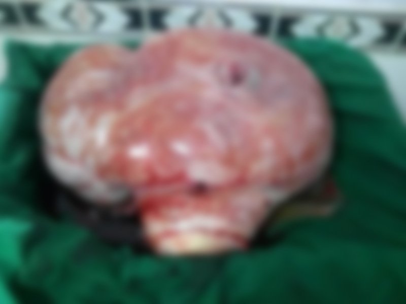 महिला के पेट से 15 किलो वजनी गांठ निकाली